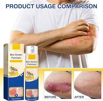 Spray Calmante para la Psoriasis con Veneno de Abeja